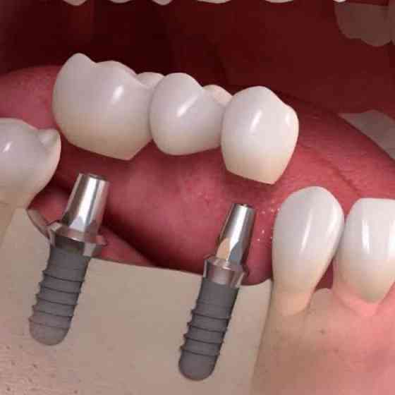 Зубные импланты Стоматология Алматы