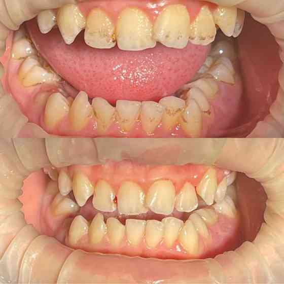 Профессиональная чистка зубов 7.000тг( ультразвук+полировка, шлифовка) Нур-Султан