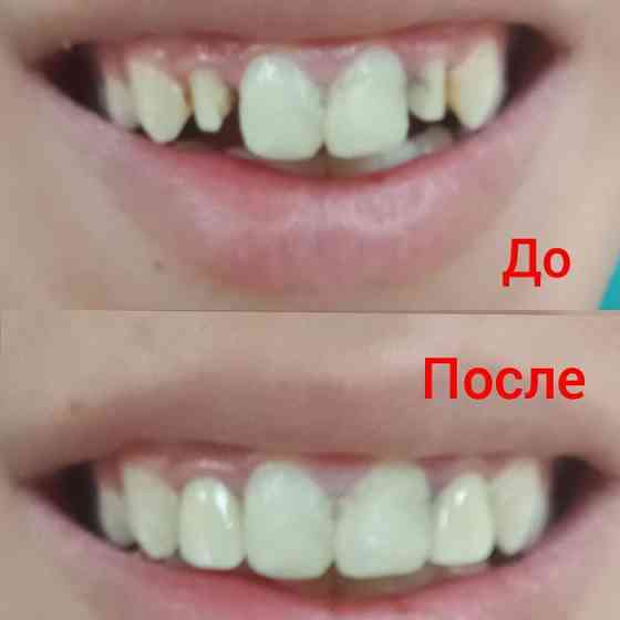 На все виды стоматологических услуг скидки Астана