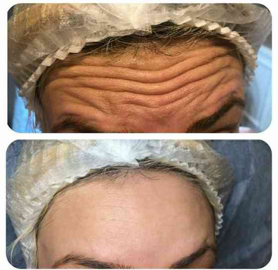 Модели нужны на плазмалифтинг биоревитализация мезотерапия лица волос Алматы